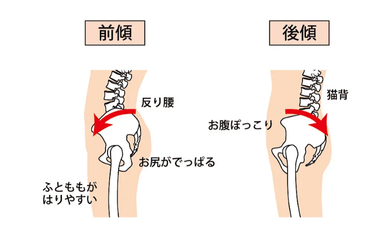骨盤前傾・骨盤後傾の比較図