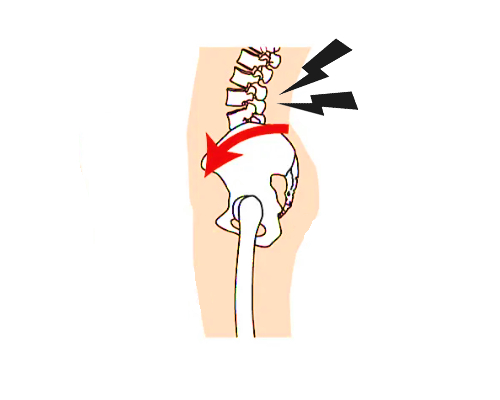腰椎の反りと痛みの画像