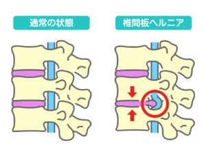 腰痛を引き起こす椎間板ヘルニアの画像