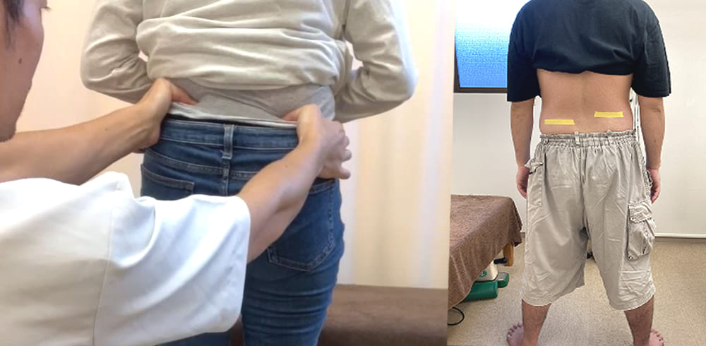 上山和俊が調べている骨盤の力学的偏位(ズレ・歪み)の写真