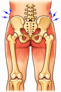 骨盤の横が痛んでいるイラスト